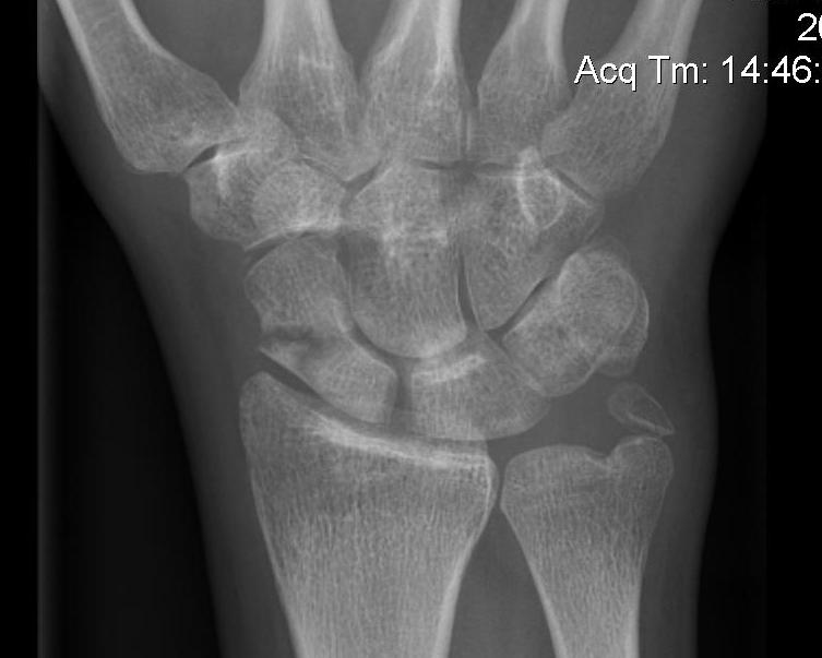 Scaphoid Fracture Complete